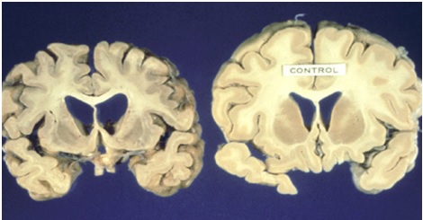 Postmortem brain samples from an HD patient (left) versus healthy control (right).